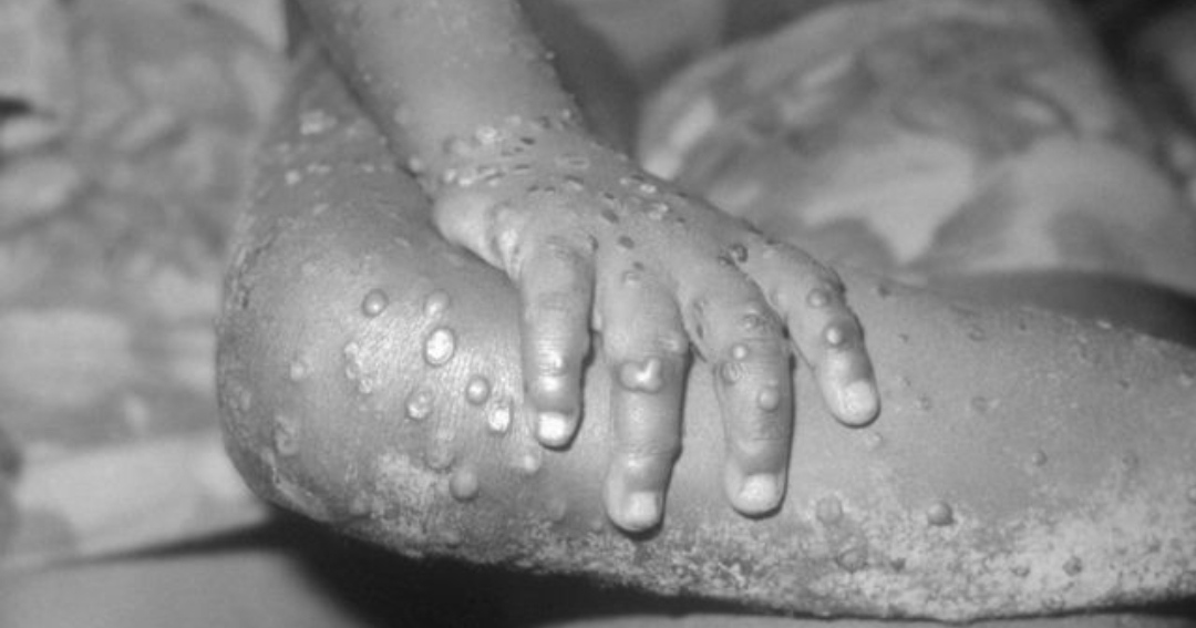 NCDC Confirms 15 Cases of Monkeypox in Nigeria